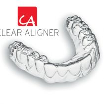 Niềng răng xong có bị hở lợi không?